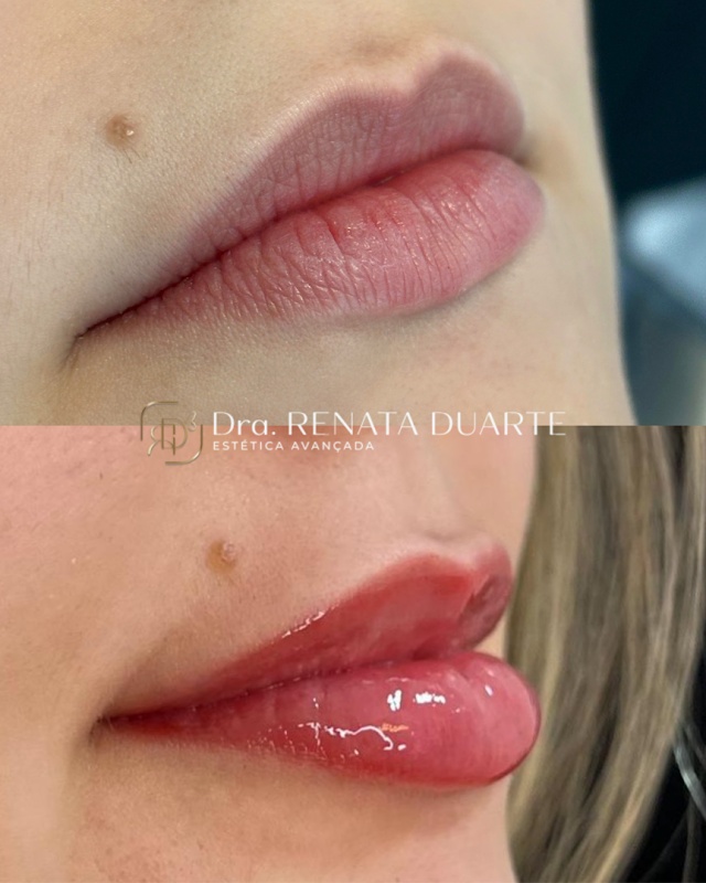 Clínica de Estética em Praia da Costa – Botox, Preenchimento Labial e Tratamento Capilar | Dra Renata Duarte - Clínica de Estética em Praia da Costa, Vila Velha/ES - Foto 5