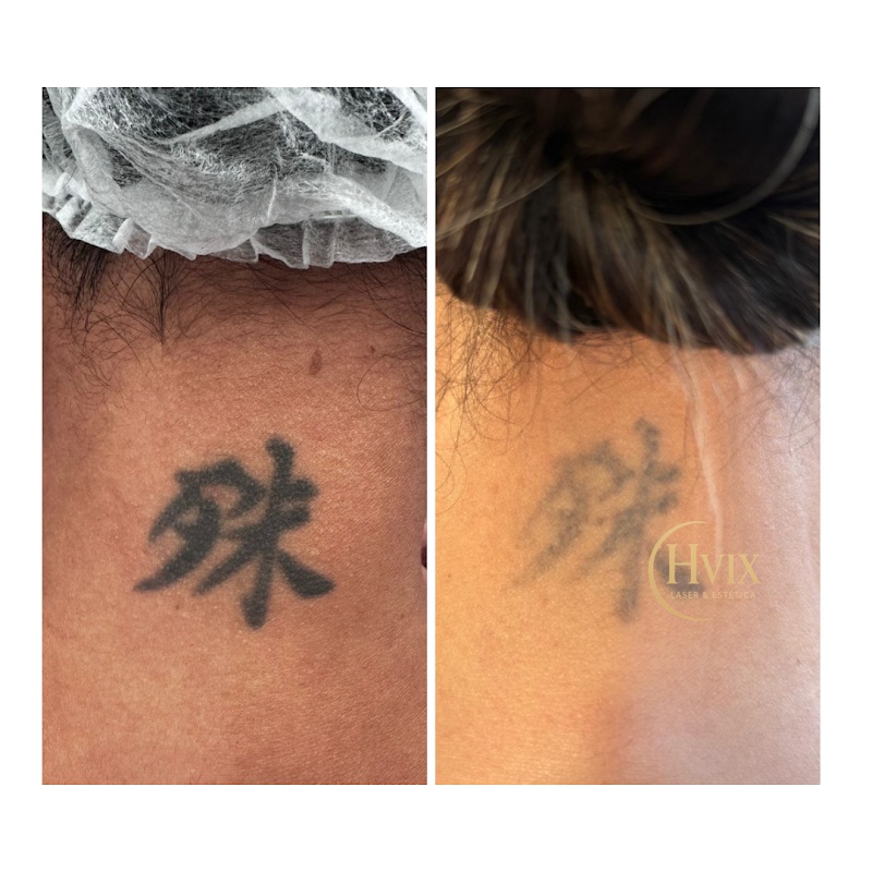 Hvix laser e Estética - Clínica de Estética em Praia da Costa, Vila Velha/ES - Foto 4